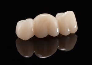 انواع تركيبات الأسنان - Types of dental prosthetics - PMMA Dental Restorations
