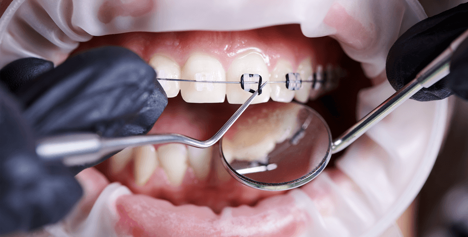إزالة تقويم الاسنان - مركز وندرز لعلاج الاسنان - Removal of dental braces