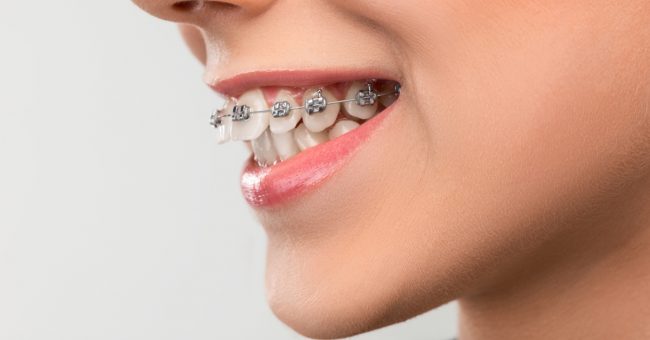 بروز الفك العلوي - Protruding Upper Jaw - tooth protrusion
