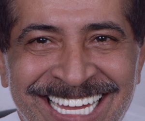 تآكل عظام الفك - Lost upper teeth - تآكل عظام الفكين - مركز وندرز لعلاج الاسنان - Jawbone Resorption