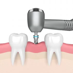 Jawbone Resorption