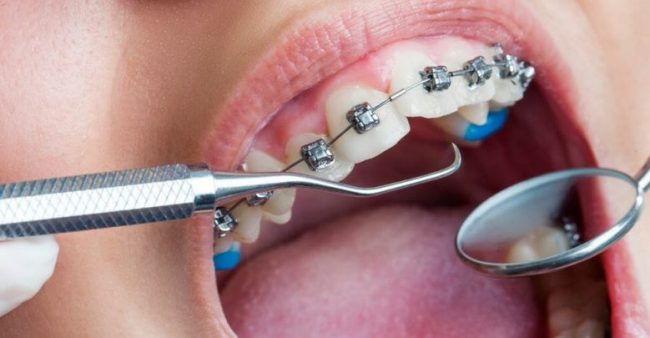 تقويم الأسنان المعدني - Metal Braces