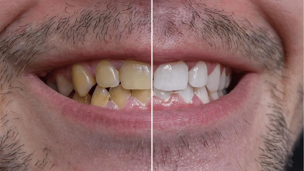 عدسات الأسنان ايماكس - مركز وندرز لعلاج الاسنان