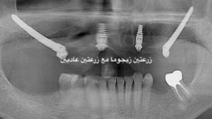 زراعة الزيجوما - مركز وندرز لعلاج الاسنان