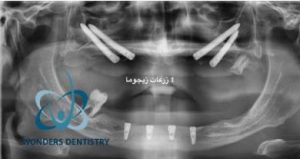 زراعة الزيجوما - مركز وندرز لعلاج الاسنان