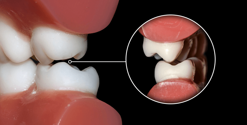 صرير الأسنان - مركز وندرز لعلاج الاسنان - Bruxism