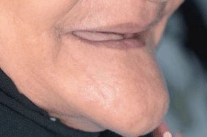 طقم أسنان متحرك - مركز وندرز لعلاج الاسنان