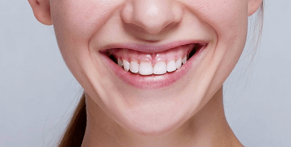 الإبتسامة اللثوية - مركز وندرز لعلاج الاسنان - gummy smile
