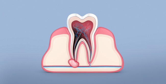 خراج الأسنان - مركز وندرز لعلاج الاسنان - خراج الاسنان