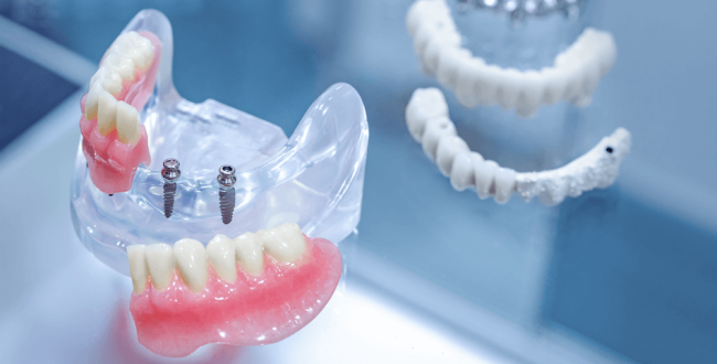 طقم الأسنان علي زراعة الأسنان - مركز وندرز لعلاج الاسنان - denture on dental implants