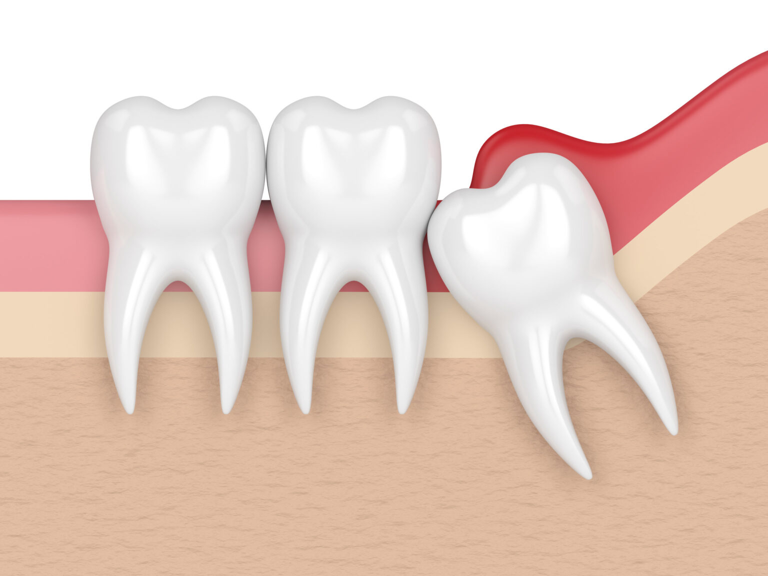 ضرس العقل - Wisdom Tooth