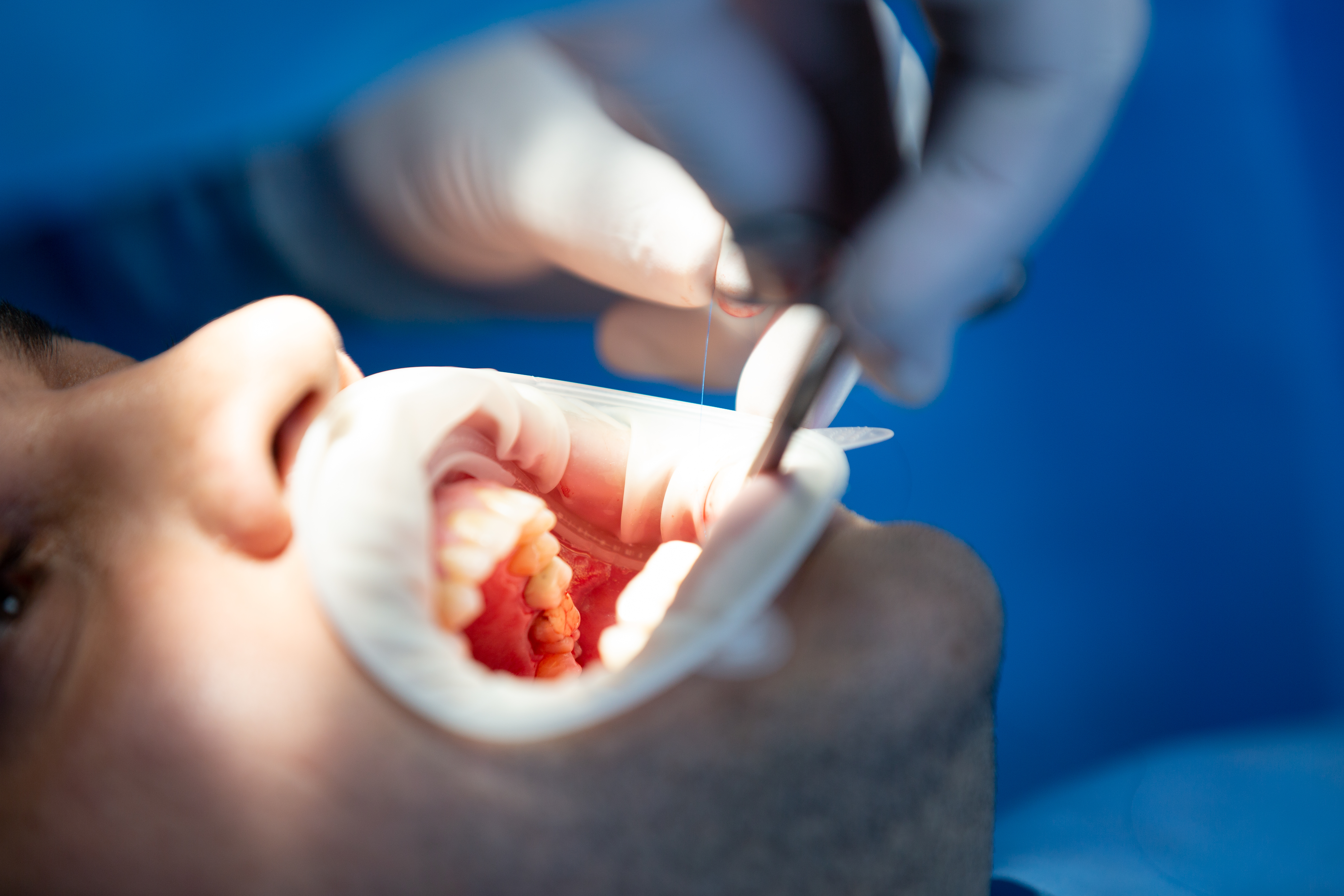 طعم اللثة - gum grafting