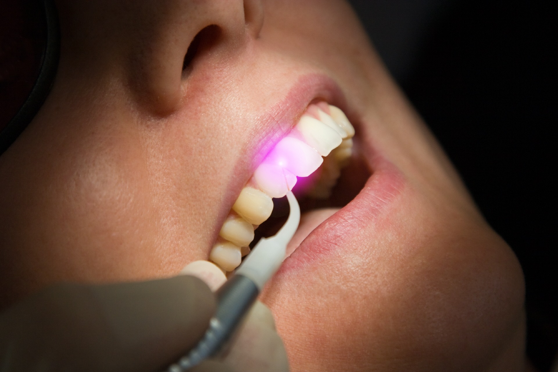 علاج قناة الجذر بالليزر - Laser Root Canal Treatment
