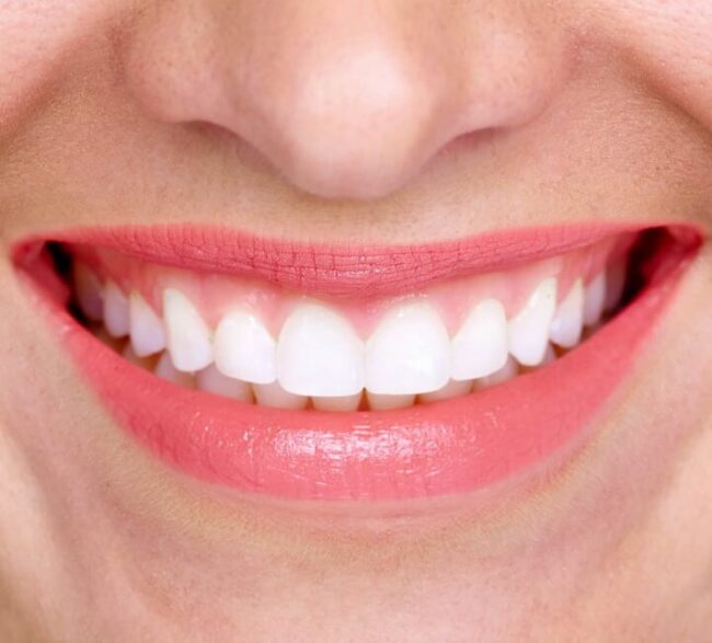 تبييض الأسنان من الداخل - internal teeth whitening