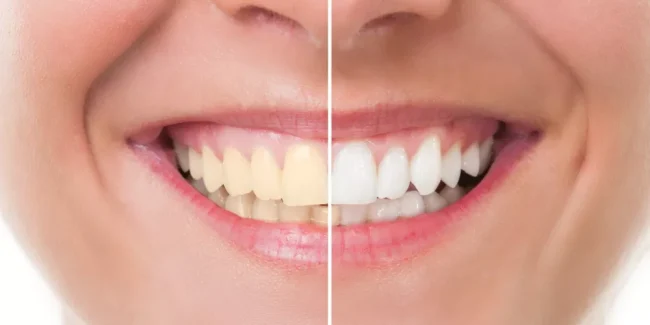 تبييض الأسنان بالليزر - مركز وندرز لعلاج الاسنان