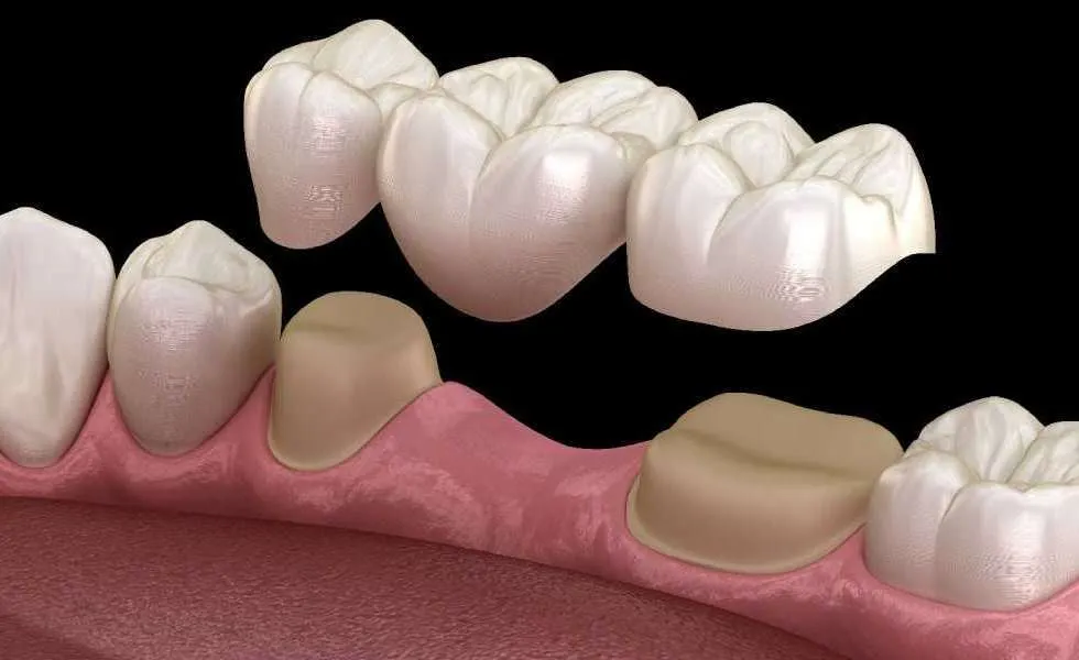 تعويض الأسنان المفقودة - Replace Missing Teeth
