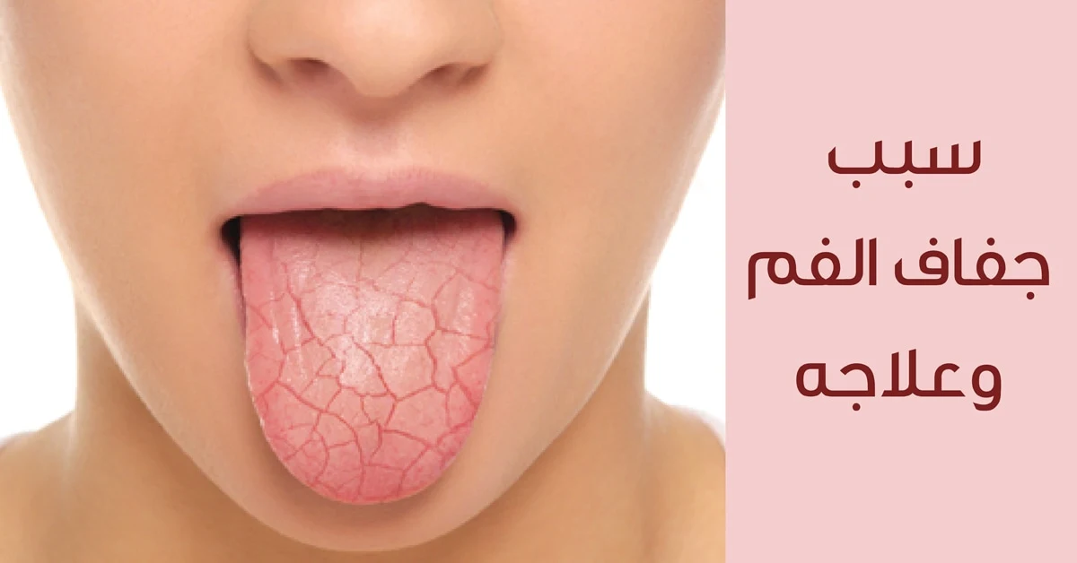 أعراض جفاف الفم وطرق علاجه - symptoms of dry mouth