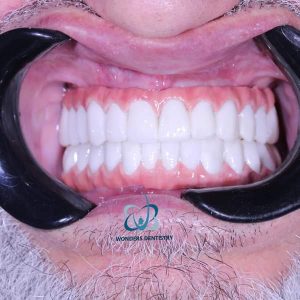 زراعة فكين - مركز وندرز لعلاج الاسنان
