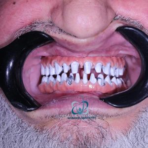 زراعة فكين - مركز وندرز لعلاج الاسنان