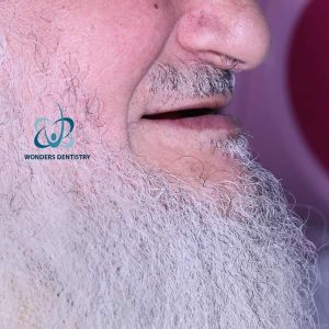 زراعة فكين - مركز وندرز لعلاج الاسنان