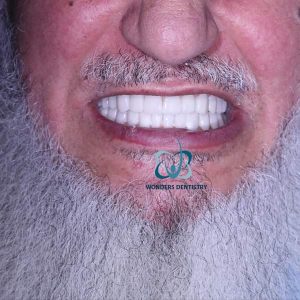 زراعة فكين - مركز وندرز لعلاج الاسنان