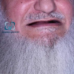 زراعة فكين - مركز وندرز لعلاج الاسنان