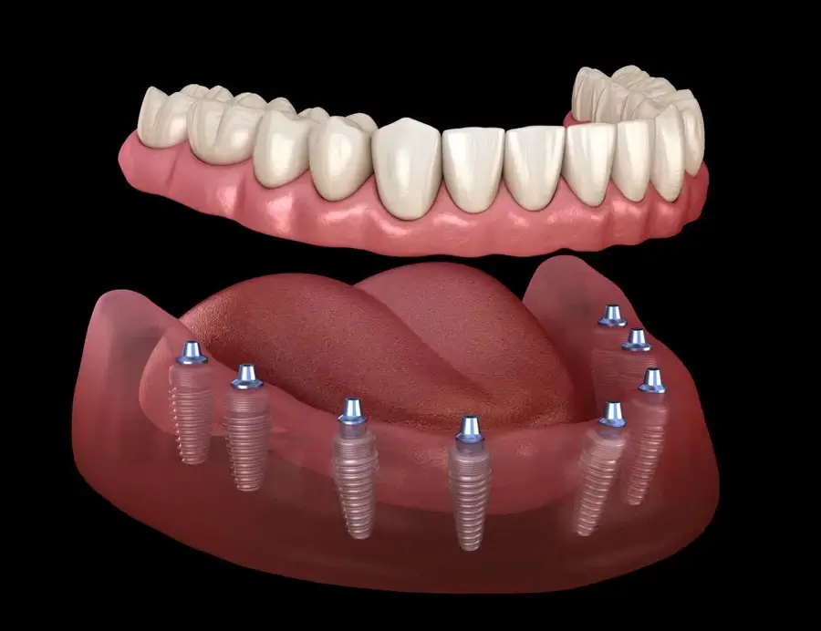 تركيبات الأسنان All on 8 - All on 8 Dental Implants
