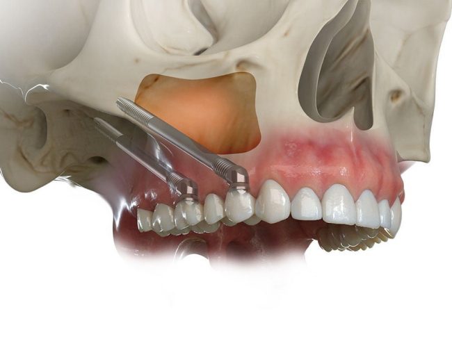 زراعة الزيجوما و التيرجويد - زراعة أسنان التيرجويد - Pterygoid dental implants