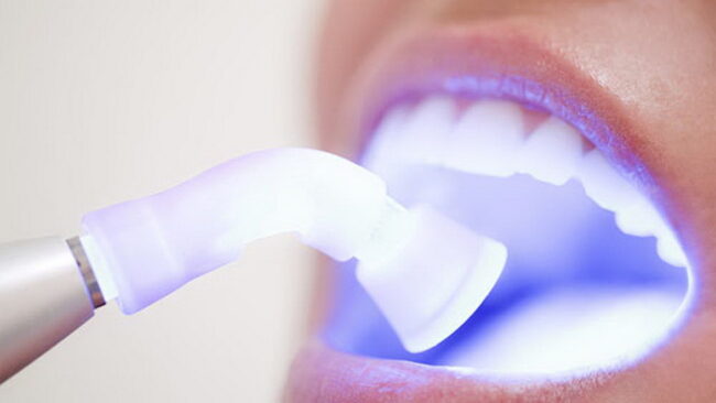 تقويم الاسنان بالليزر - Laser orthodontics