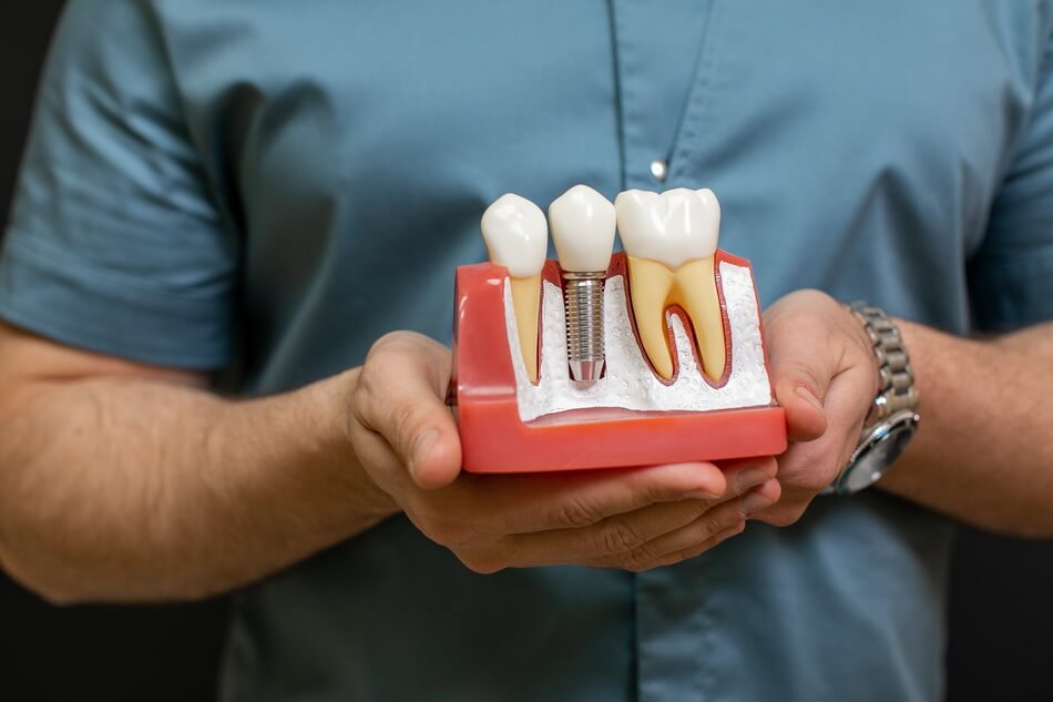مميزات زراعة الأسنان - Advantages of Dental Implants