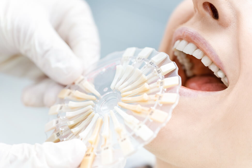 تبييض الأسنان بالليزر و الكيميائي - Laser And Chemical Teeth Whitening