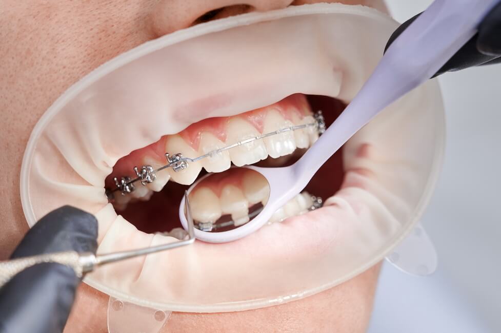كسر تقويم الأسنان - Breaking braces