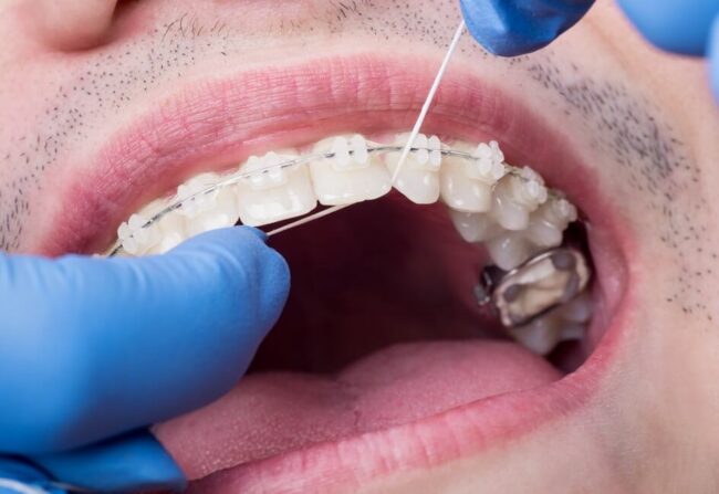 تقويم الاسنان الخزفي - Ceramic Braces