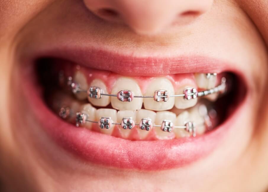 اجراء تقويم الأسنان - Orthodontic procedure
