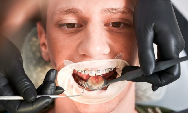 تقويم الأسنان الوقائي و التقويم العلاجي - Preventive and Therapeutic Orthodontics