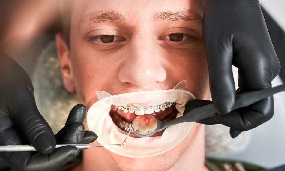 تقويم الأسنان الوقائي و التقويم العلاجي - Preventive and Therapeutic Orthodontics